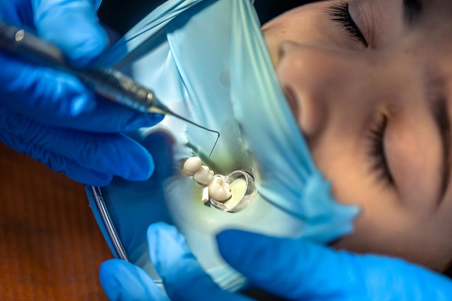 Root Canal Procedure Using Dental Rubber Dam for Tooth Isolation